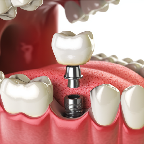 Implant Crown