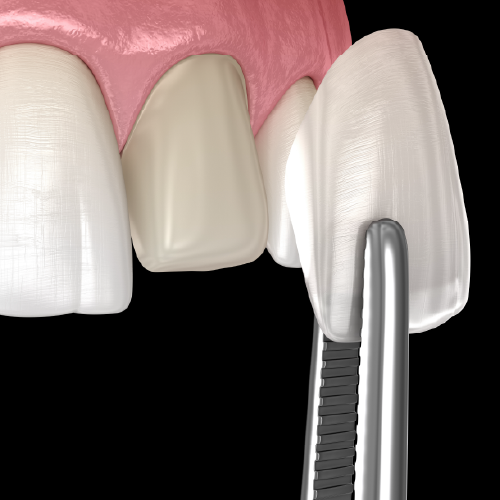 Veneer
